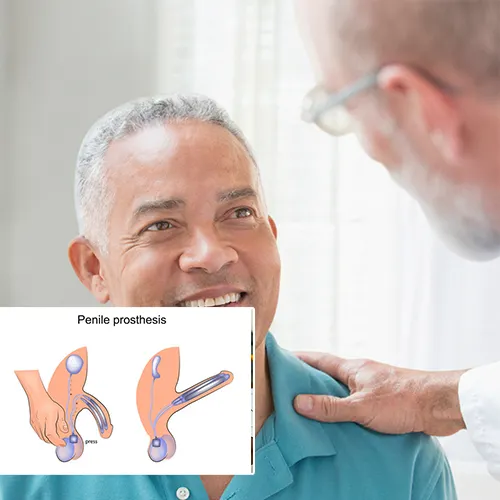 Welcome to  Florida Urology Partners 
Your Trusted Partner in Penile Implant Support